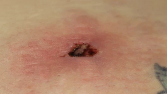 A necrotic skin wound from a brown recluse spider bite 