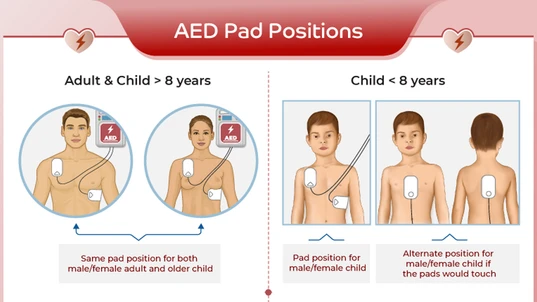 Positioning of AED electrode pads