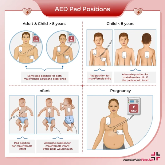 AED pad positions for adult, child, infant, and pregnant patients