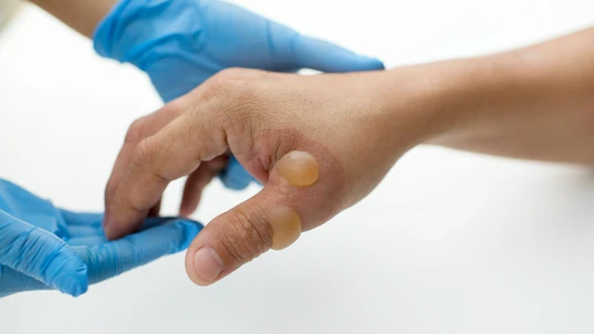 Blisters on burnt hand being examined by a doctor