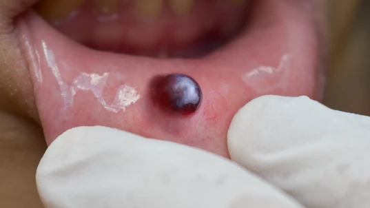 Blood blister inside the mouth