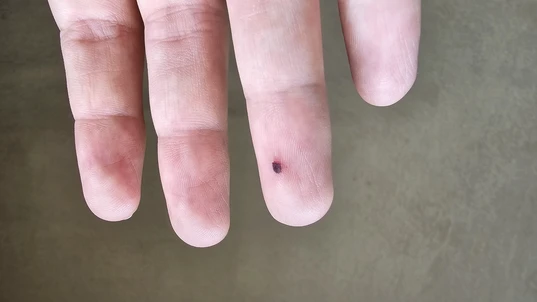 Blood blister on fingertip