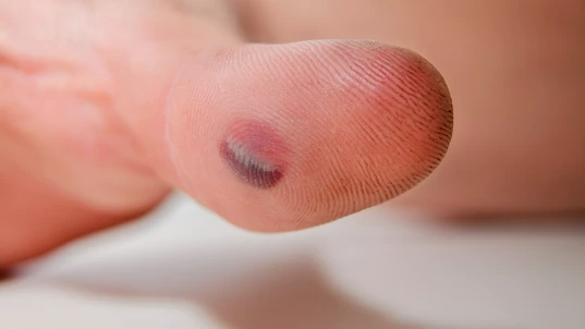 Blood blister on adult thumb