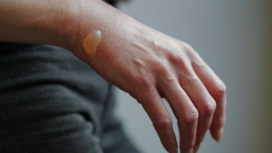 Second degree burn blister on woman's hand