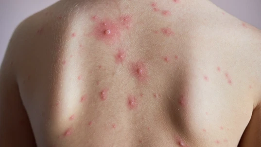 Chicken pox blister on back of a child