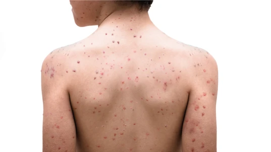 Chickenpox disease, boy on his back and sick. Chickenpox virus, chicken pox outbreak in children.