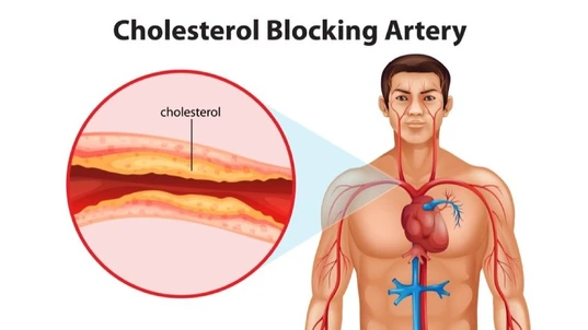 Cholesterol blocking artery man