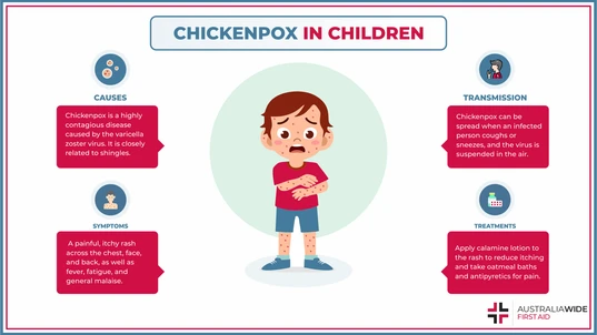 Infographic on Chickenpox in Children 