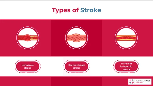 Infographic Showing Three Different Types of Stroke 