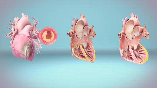 3D Medical animation still depicting Heart Attack, Cardiac Arrest and Heart Failure