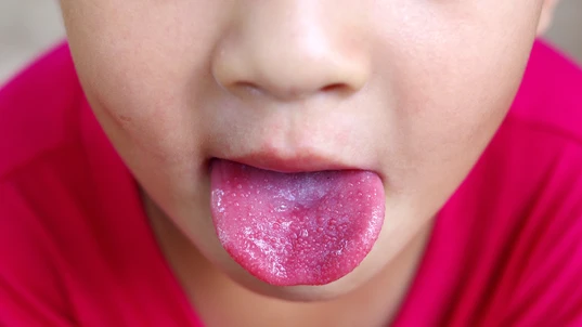 strawberry tongue , scarlet fever