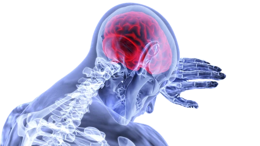 Illustration of Stroke showing brain inflammation