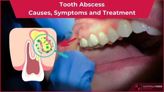 Tooth Abscess article header