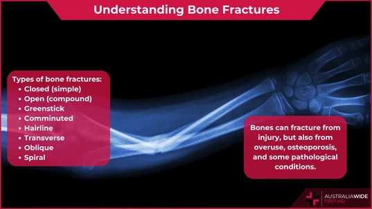 Understanding Bone Fractures article header